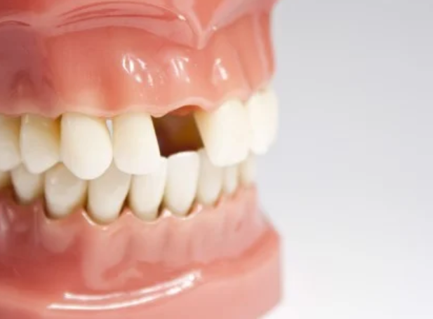 Trồng Răng Implant – Cấy Ghép Implant Chuẩn Quốc Tế