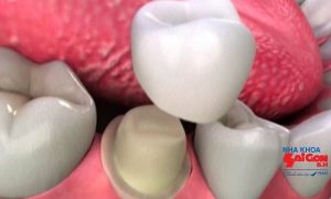 Các bước bọc răng sứ như thế nào sẽ an toàn?