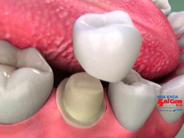 Các bước bọc răng sứ như thế nào sẽ an toàn?