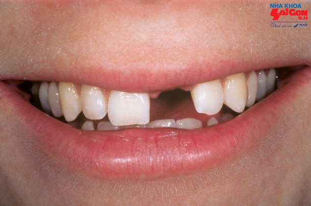 Những phương pháp trồng răng cửa cố định hiệu quả nhất