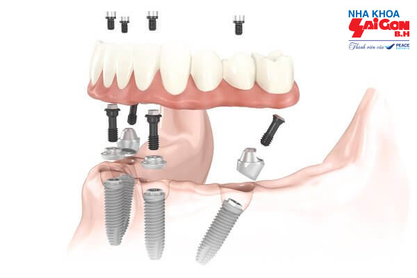 Implant – Phương pháp trồng răng giả số 7 đơn giản mà hiệu quả