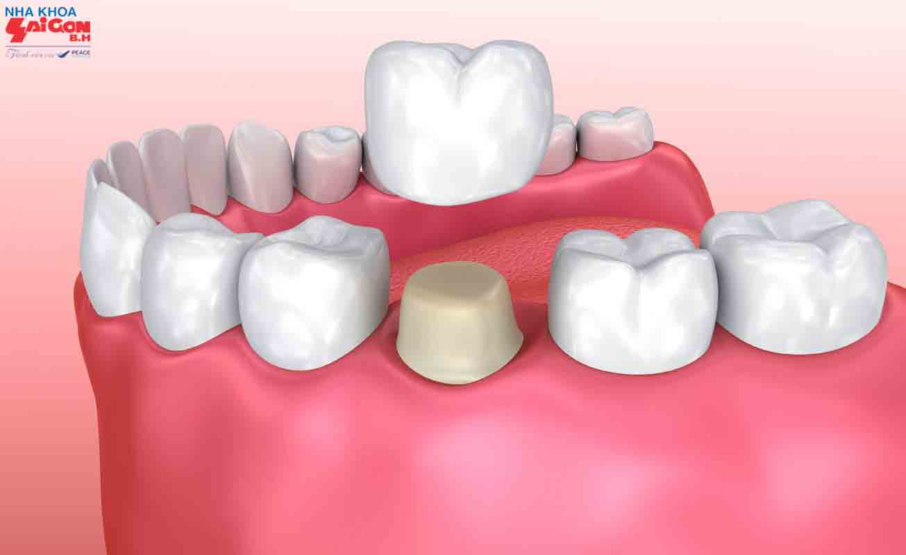 Bọc răng sứ bị cộm do đâu và làm thế nào khắc phục