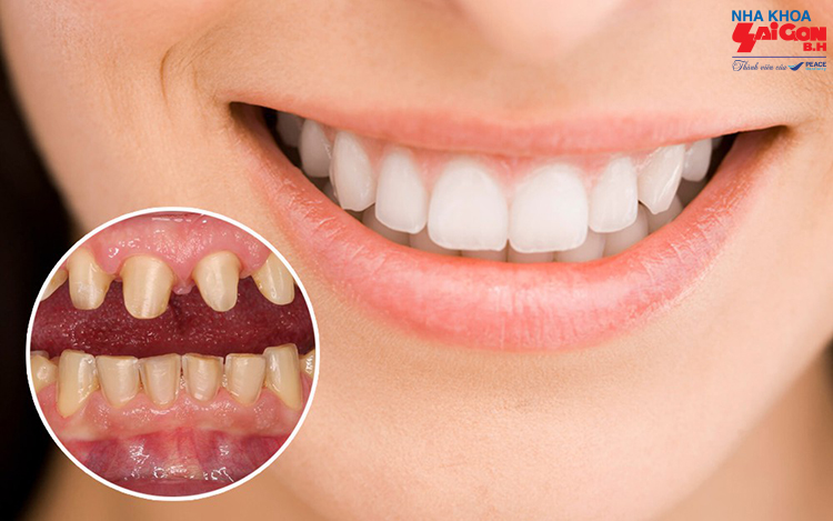 Khi nào nên sử dụng phương pháp bọc răng sứ?