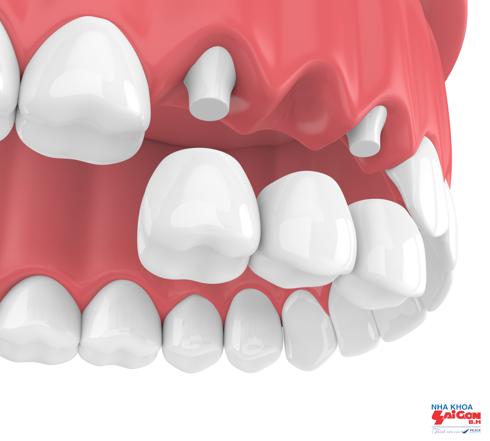 Trồng răng sứ bằng phương pháp bắc cầu có ưu điểm gì?
