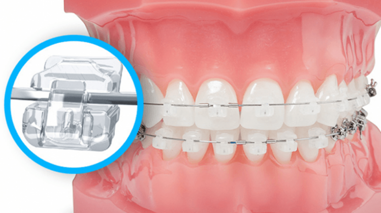Phương pháp chỉnh nha niềng răng là gì