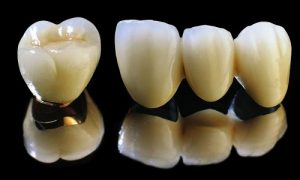 Bọc răng sứ titan giá bao nhiêu là đảm bảo chất lượng