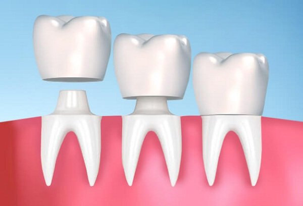 Bọc răng sứ có gây nên tình trạng hôi miệng hay không?