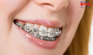 Ưu điểm của phương pháp niềng răng kim loại