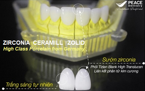 Răng toàn sứ Zirconia Ceramill Zolid và những ưu điểm nổi bật