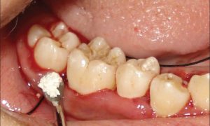 Nhổ răng số 7 có nguy hiểm không ?