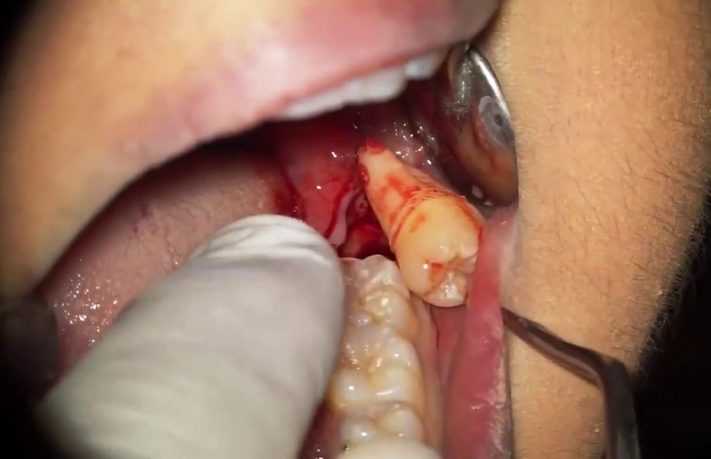 Nhổ răng khôn hàm dưới có nguy hiểm không ?