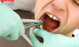 Răng khôn hàm trên mọc lệch là gì ?