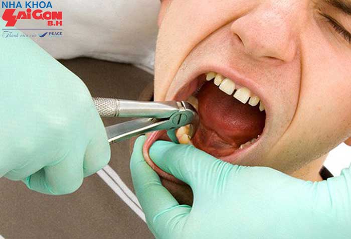 Răng khôn hàm trên mọc lệch là gì ?