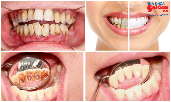 Tác dụng của lấy cao răng với sức khỏe răng miệng
