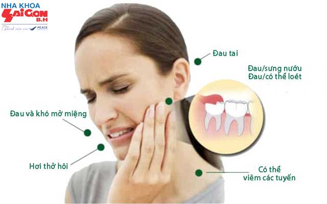 Viêm lợi trùm răng khôn và cách điều trị