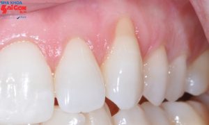 5 cách chữa tụt lợi chân răng ngay tại nhà