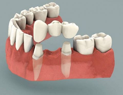 Trồng răng sứ – giải pháp tối ưu cho người mất răng lâu năm