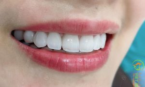 Xử lý răng thưa an toàn hiệu quả
