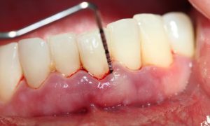 Cao răng viêm lợi: Nguyên nhân và cách điều trị ra sao?