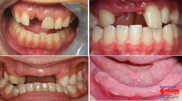 Thông tin cần biết về trồng răng implant nguyên hàm