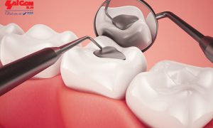 Tư vấn trám răng sâu có nguy hiểm không?