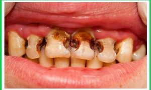 Liệu nhức răng có nên nhổ không?