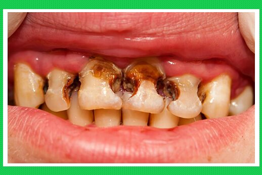 Liệu nhức răng có nên nhổ không?
