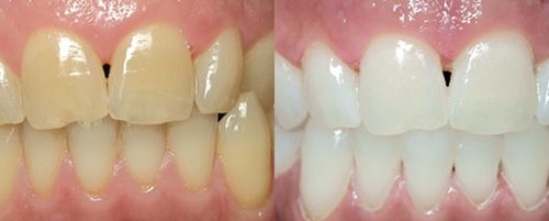 Dấu hiệu của răng nhiễm kháng sinh là gì?