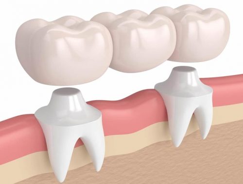 Giải pháp khắc phục triệt để tình trạng làm cầu răng sứ bị viêm lợi