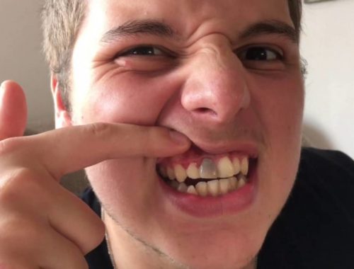 Tư vấn cách xử lý răng bị đen ở chân răng