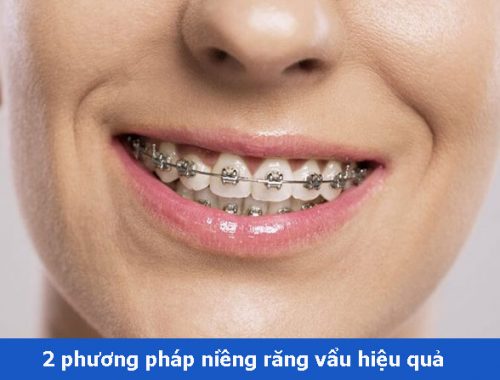 2 phương pháp niềng răng hô vẩu – Giá hết bao nhiêu tiền