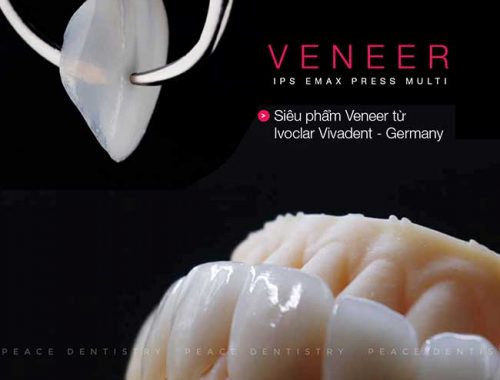Mặt dán sứ Veneer Emax Press và IPS Emax – Bảng giá chi tiết