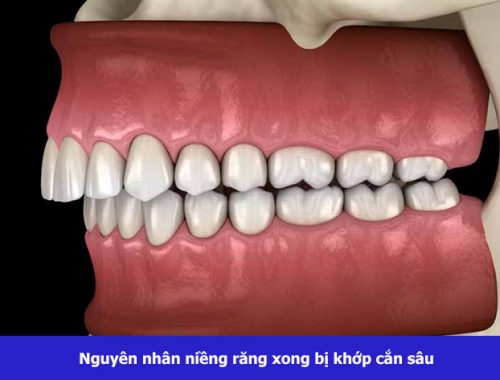 Sau khi niềng răng xong bị khớp cắn sâu – Chẩn đoán và điều trị