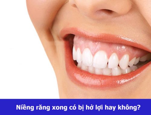 Hỏi Đáp: Sau khi niềng răng có bị hở lợi hay không?