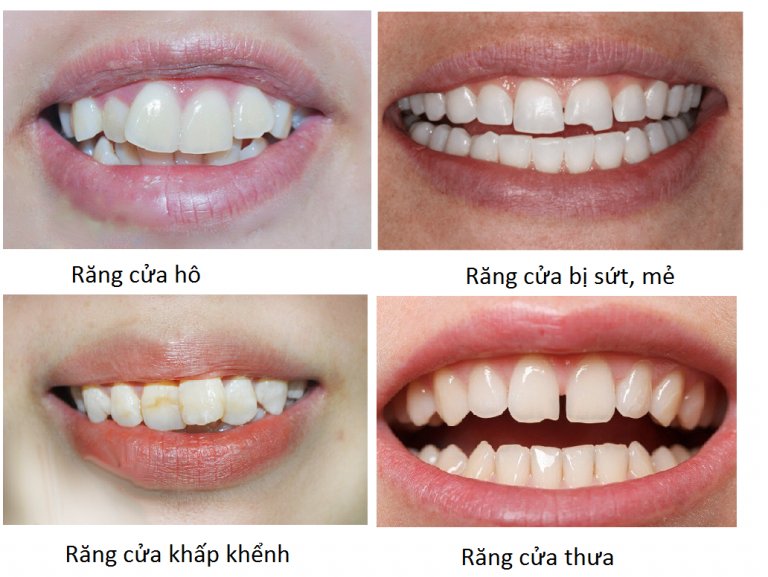 Bọc sứ răng cửa thưa mẻ lệch hô – Giá bọc sứ răng cửa bao nhiêu