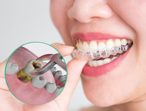 Niềng răng invisalign có nhổ răng không và có đau không?