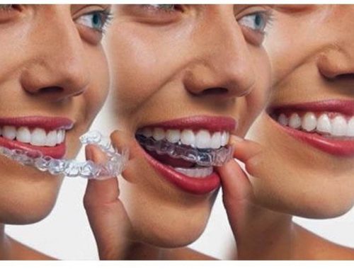 Niềng răng không mắc cài Invisalign mất bao lâu – Có tốt hiệu quả không