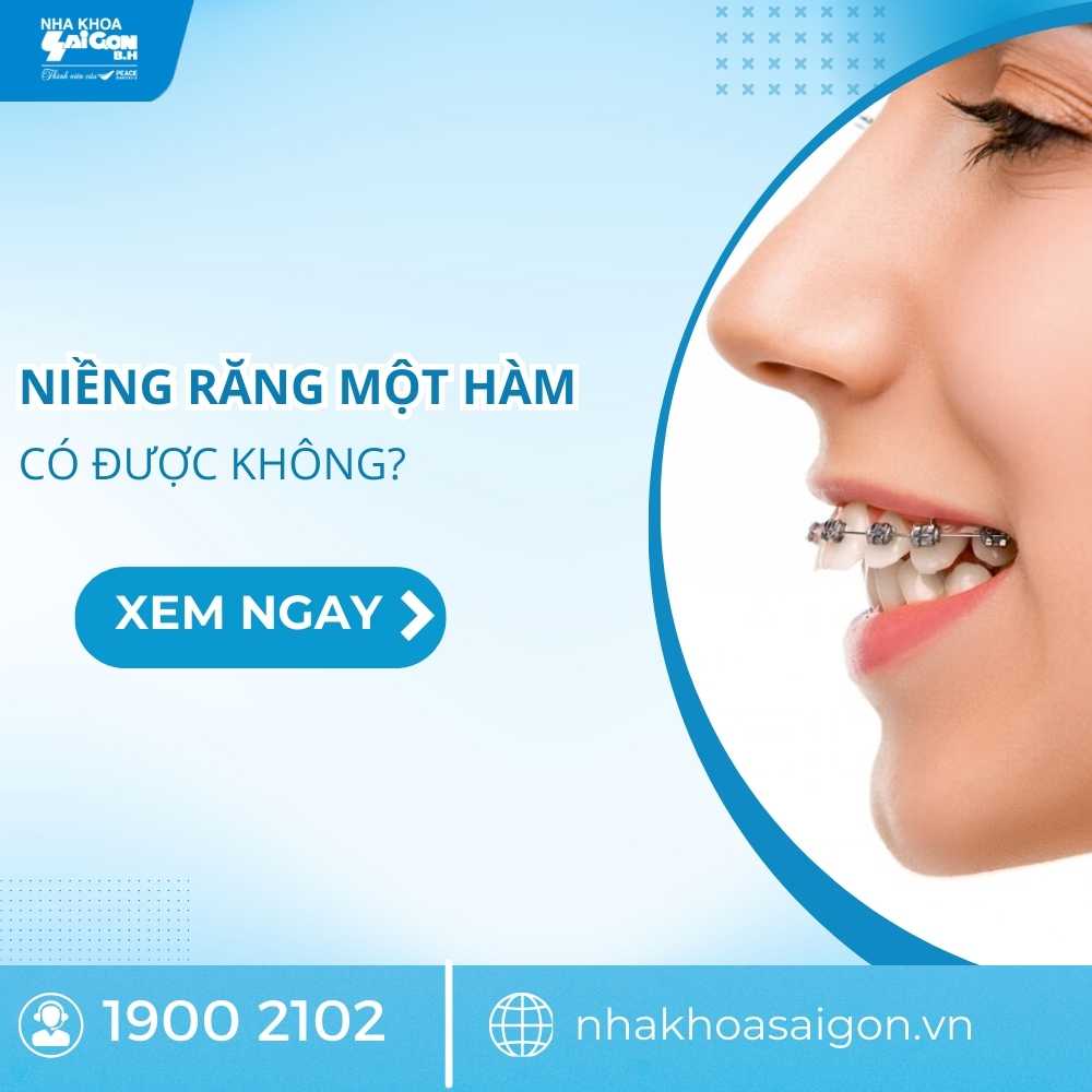 Niềng răng một hàm có được không? Trường hợp nào phù hợp niềng răng một hàm